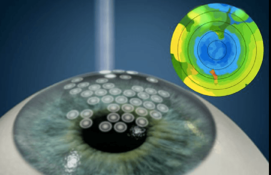 Lens-Based Refractive Surgery
